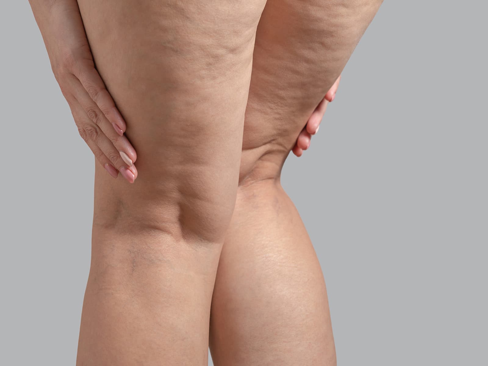 Lipödem-Operationen: Wann ist eine Liposuktion sinnvoll?